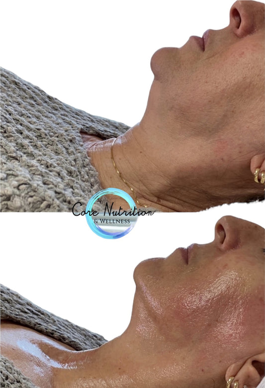 Neveskin Facial - 10 Sessions