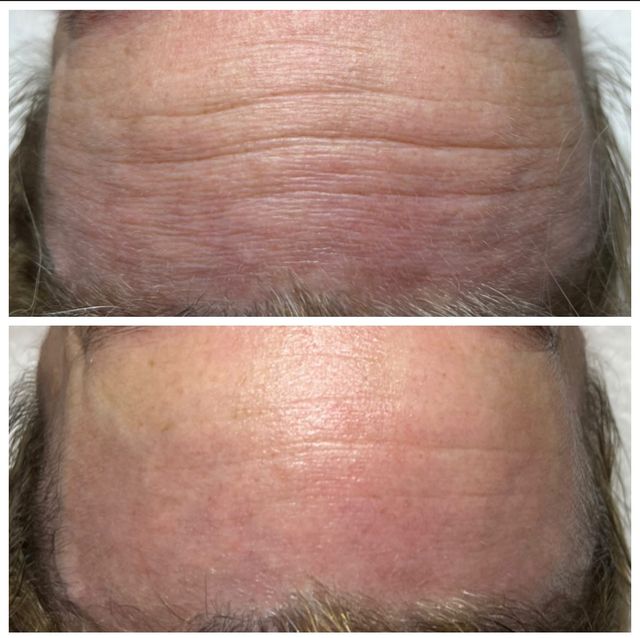 Neveskin Facial - 1 Session