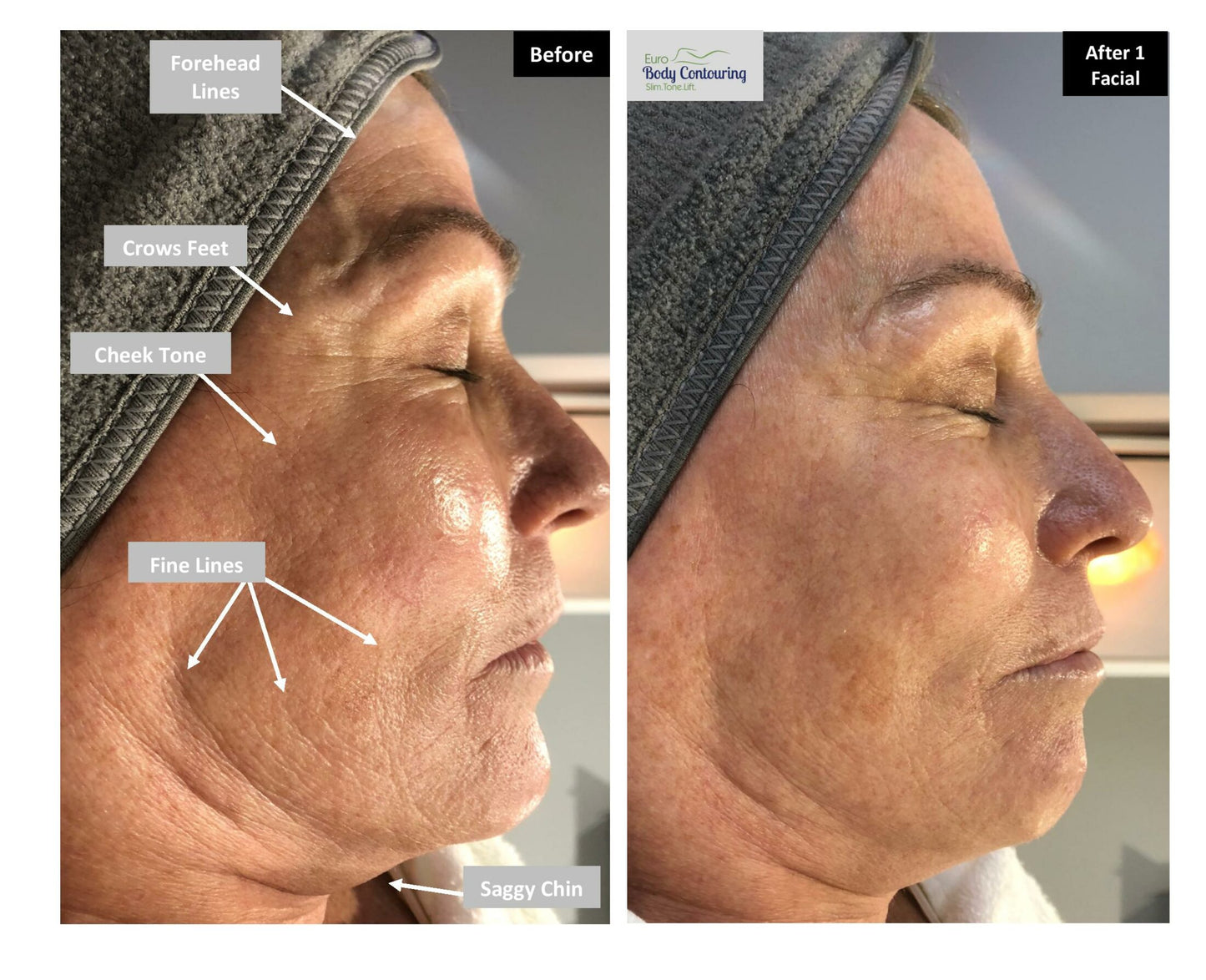 Neveskin Facial - 1 Session