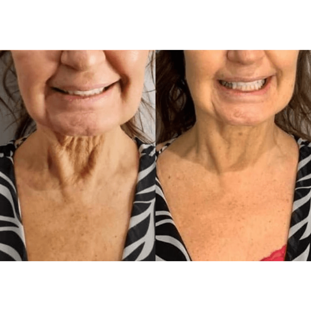 Neveskin Facial - 1 Session