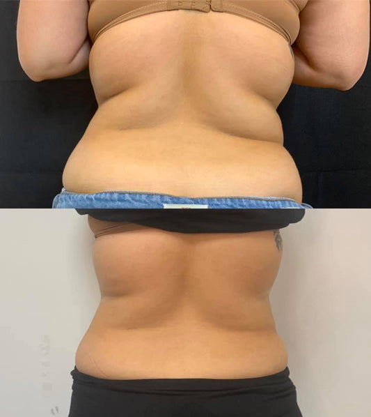 Neveskin Shape - 10 Sessions