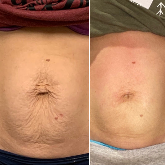 Neveskin Tone - 1 Session