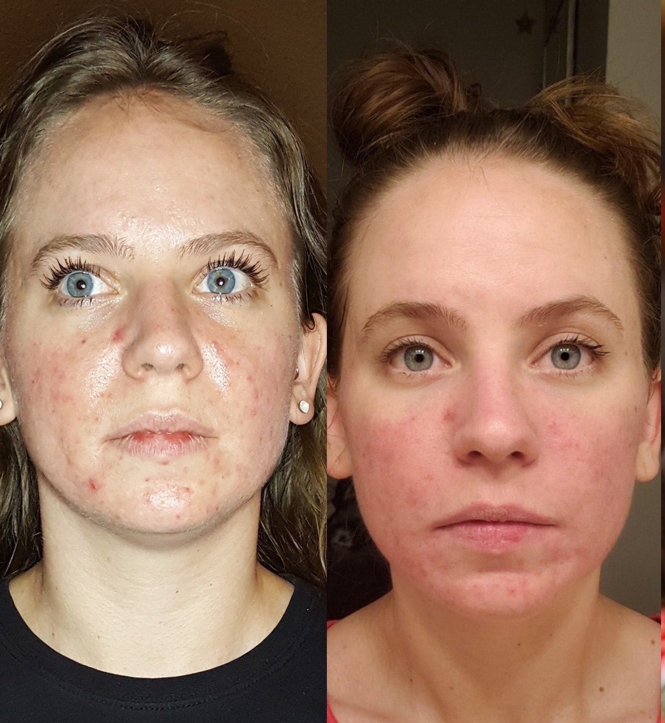 Neveskin Facial - 1 Session