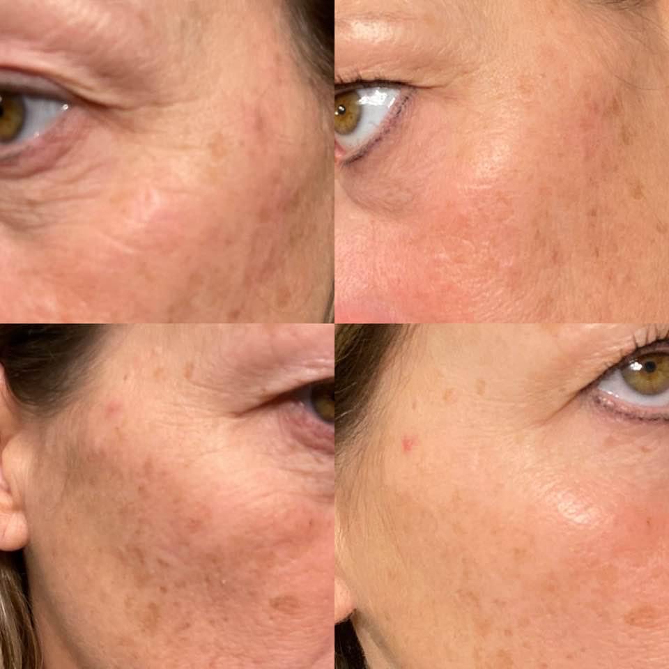Neveskin Facial - 1 Session