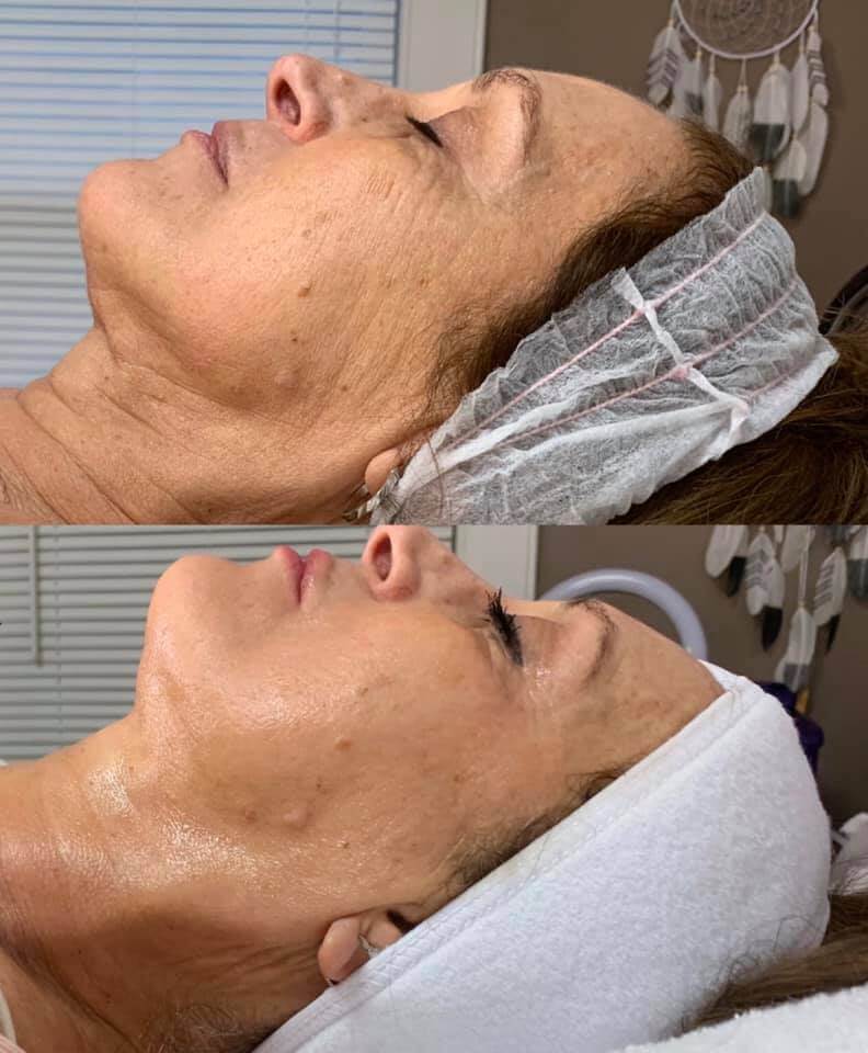 Neveskin Facial - 1 Session