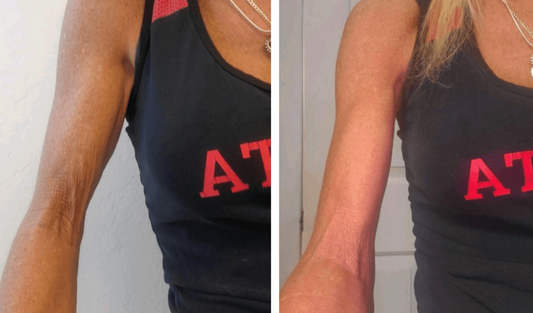 Neveskin Tone - 10 Sessions