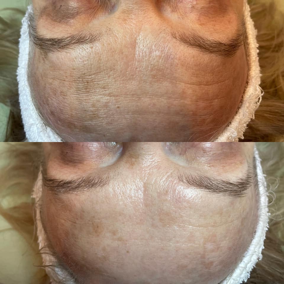 Neveskin Facial - 1 Session
