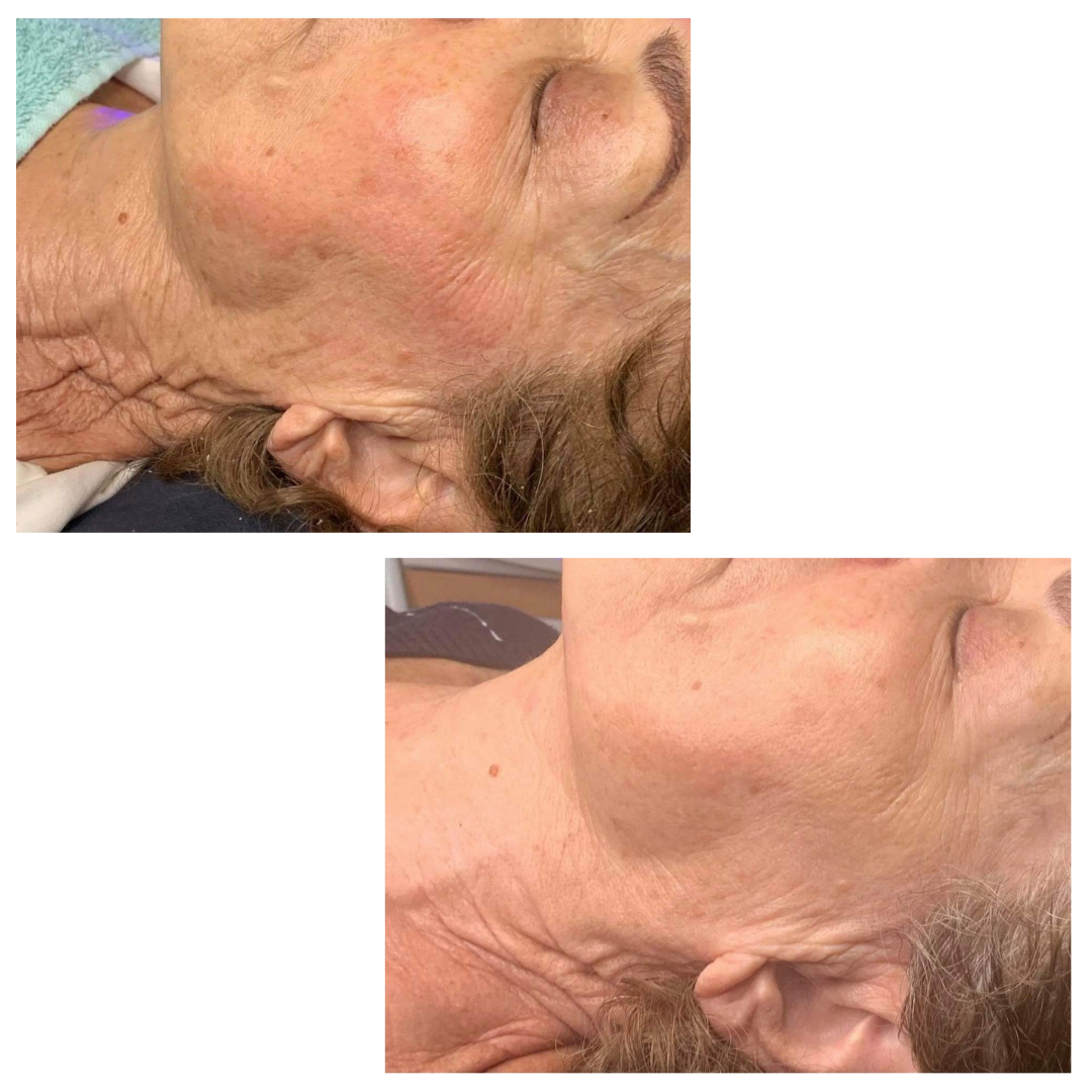 Neveskin Facial - 1 Session