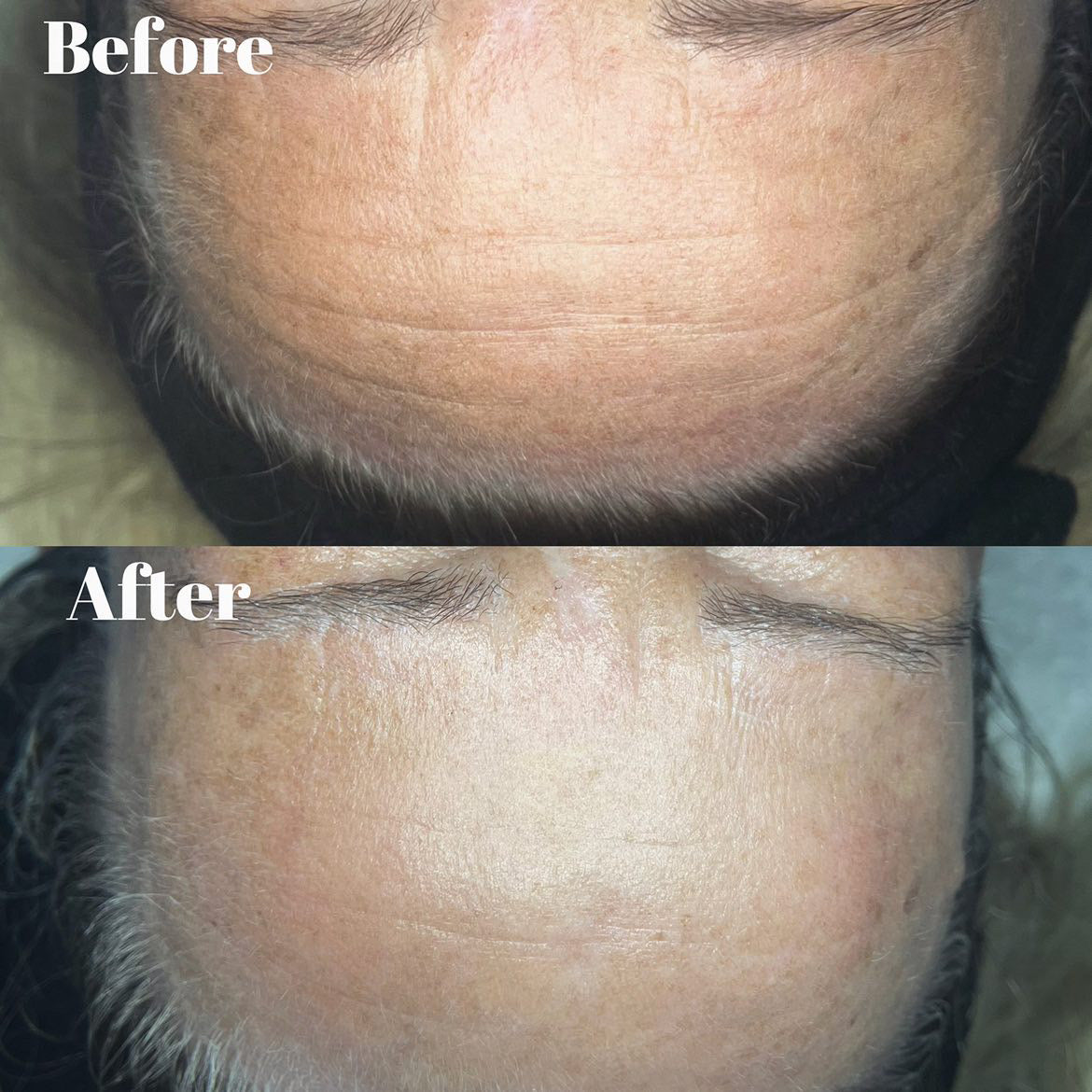 Neveskin Facial - 1 Session